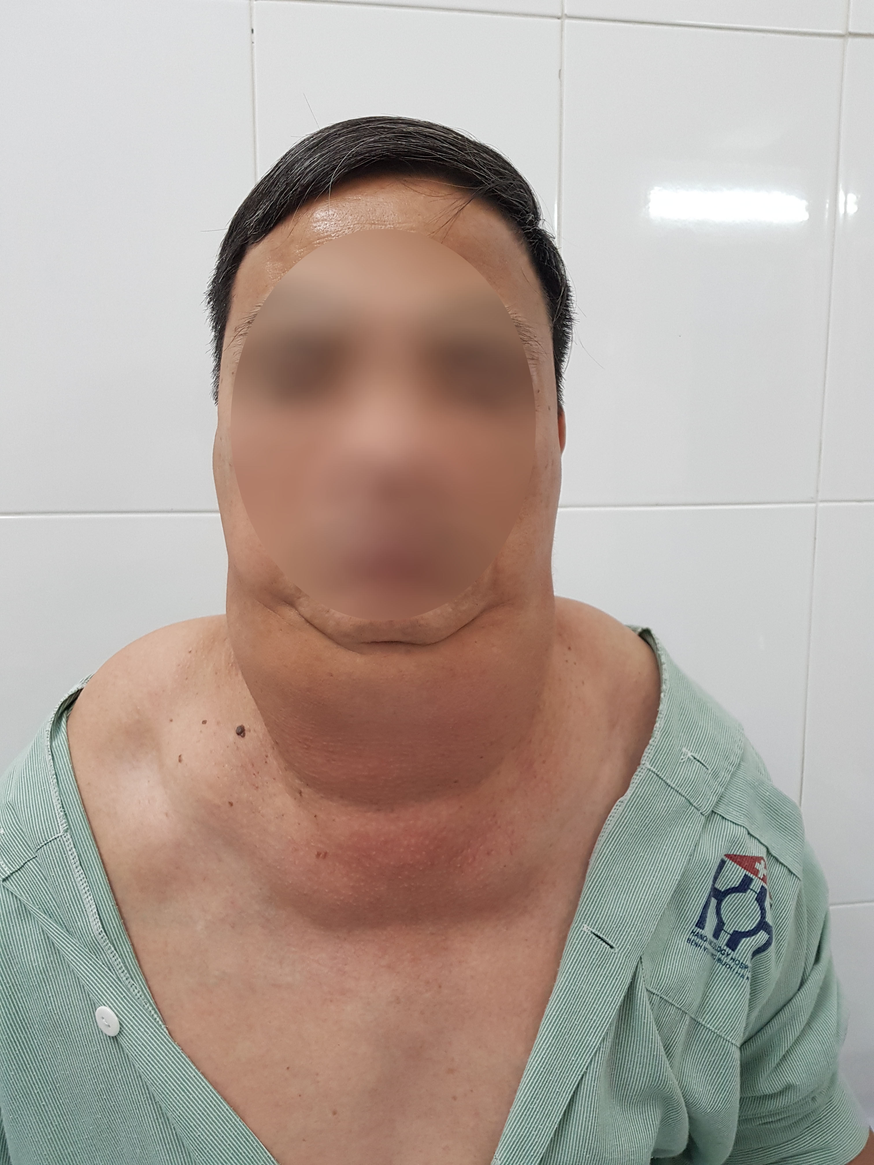 40 năm nghiện rượu, người đàn ông bị biến dạng mặt, vai, cổ 40 nam nghien ruou nguoi dan ong bi bien dang mat vai co