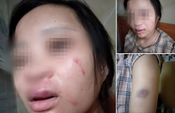 Thai phụ 8 tháng bị chồng đánh bầm dập vì mua đồ online
