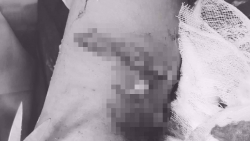 nhet pin dien tu vao tai be trai 5 tuoi bi thung mang nhi