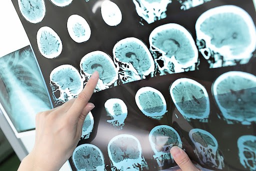 Cách sống khỏe mỗi ngày cho người bị tai biến Cách sống khỏe mỗi ngày cho người bị tai biến