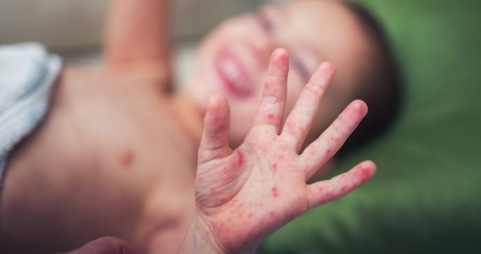 Bệnh tay chân miệng bùng phát ở trẻ vào mùa mưa bão benh tay chan mieng bung phat o tre vao mua mua bao
