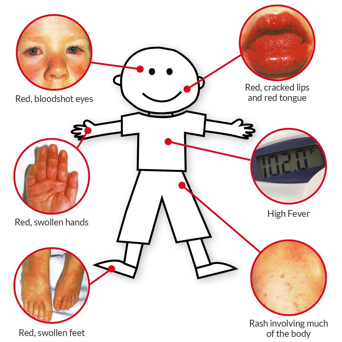 Kawasaki disease: What to know about emerging complication during COVID-19 pandemic kawasaki disease what to know about emerging complication during covid 19 pandemic