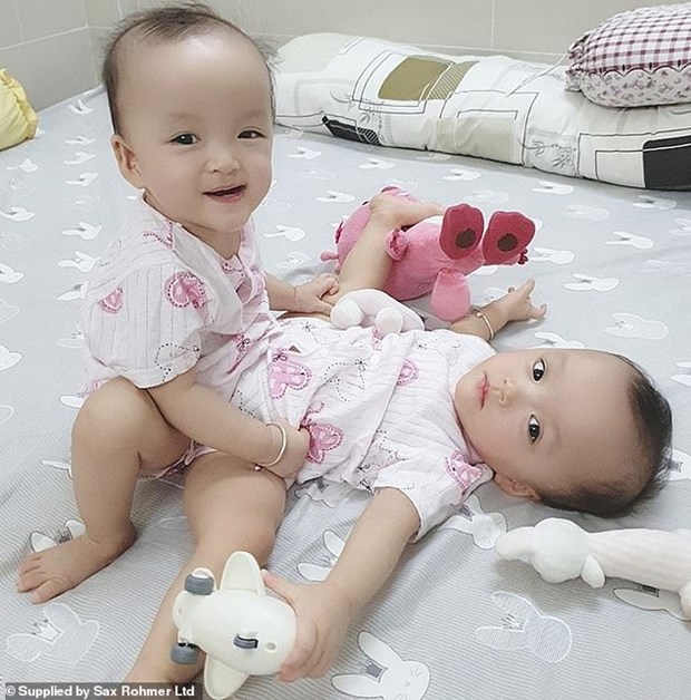 International press highlights operation to separate conjoined twins in Vietnam hình ảnh 1 International press highlights operation to separate conjoined twins in Vietnam hinh anh 1
