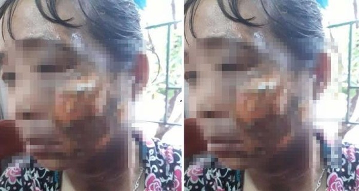 Tin mới vụ chồng hắt nước sôi vào vợ ở Đô Lương, Nghệ An tin moi vu chong hat nuoc soi vao vo o do luong nghe an