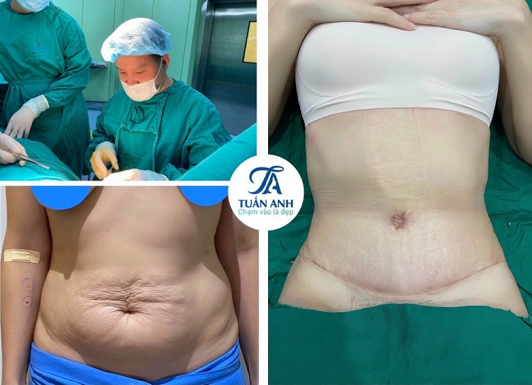 Tạm biệt mặc cảm bụng bèo nhèo, tự tin khoe đường cong cơ thể nhờ tạo hình thành bụng Tạm biệt mặc cảm bụng bèo nhèo, tự tin khoe đường cong cơ thể nhờ tạo hình thành bụng
