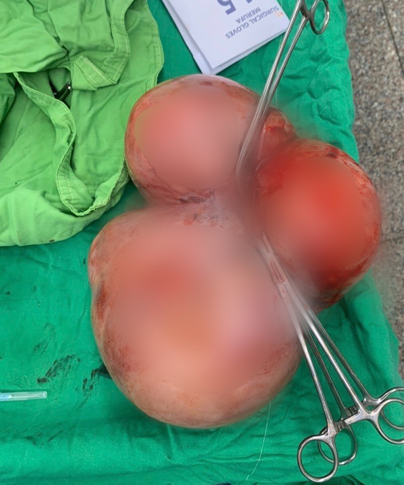 Cần Thơ: Phẫu thuật thành công khối U xơ tử cung “khủng 5,5 kg” Cần Thơ: Phẫu thuật thành công khối U xơ tử cung “khủng 5,5 kg”