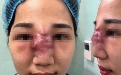 tiem filler nang mui thieu nu 21 tuoi o binh phuoc bi mu mat