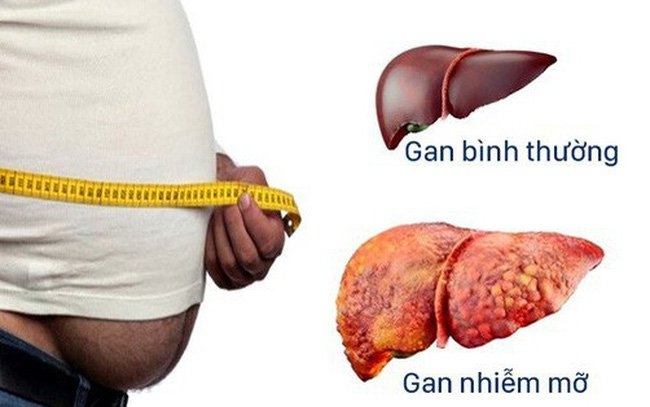 benh gan nhiem mo khong do ruou nguyen nhan va cach dieu tri