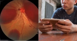 thieu nu 15 tuoi bi mu mat vinh vien sau tiem filler nang mui gia 15 trieu