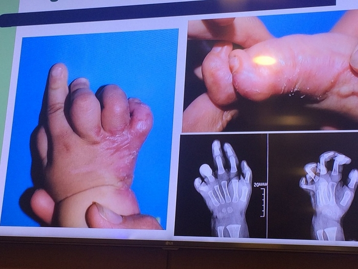 Children Action giúp 9 em nhỏ Việt Nam phẫu thuật miễn phí sẹo di chứng bỏng chuyen gia nuoc ngoai mang lai hi vong cho tre bi seo di chung bong