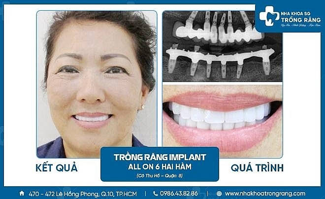 Nha khoa trồng răng Sài Gòn – Địa chỉ trồng răng uy tín, chất lượng Nha khoa trồng răng Sài Gòn – Địa chỉ trồng răng uy tín, chất lượng
