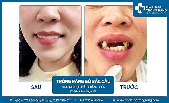 Nha khoa trồng răng Sài Gòn – Địa chỉ trồng răng uy tín, chất lượng Nha khoa trồng răng Sài Gòn – Địa chỉ trồng răng uy tín, chất lượng