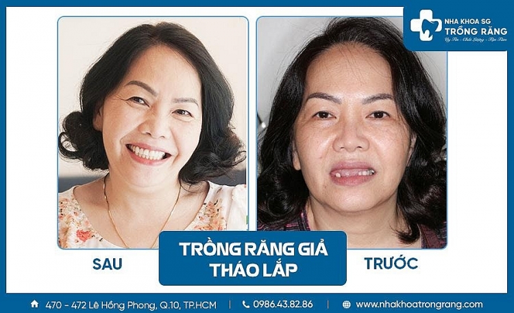 Nha khoa trồng răng Sài Gòn – Địa chỉ trồng răng uy tín, chất lượng Nha khoa trồng răng Sài Gòn – Địa chỉ trồng răng uy tín, chất lượng