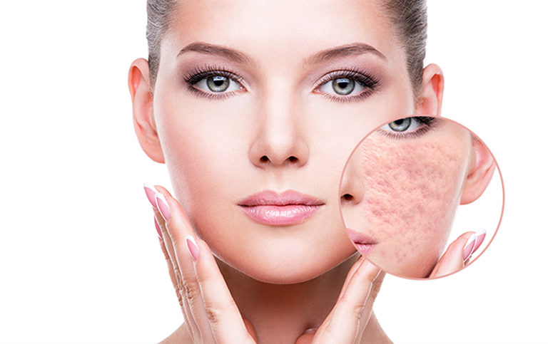 Dịch vụ điều trị sẹo rỗ tận gốc tại Seoul Spa có ưu điểm gì ?