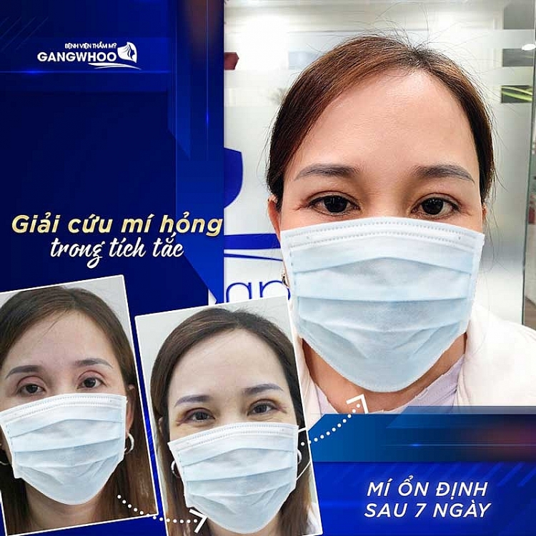 Sửa mí mắt hỏng uy tín tại Bệnh viện thẩm mỹ Gangwhoo Sửa mí mắt hỏng uy tín tại Bệnh viện thẩm mỹ Gangwhoo