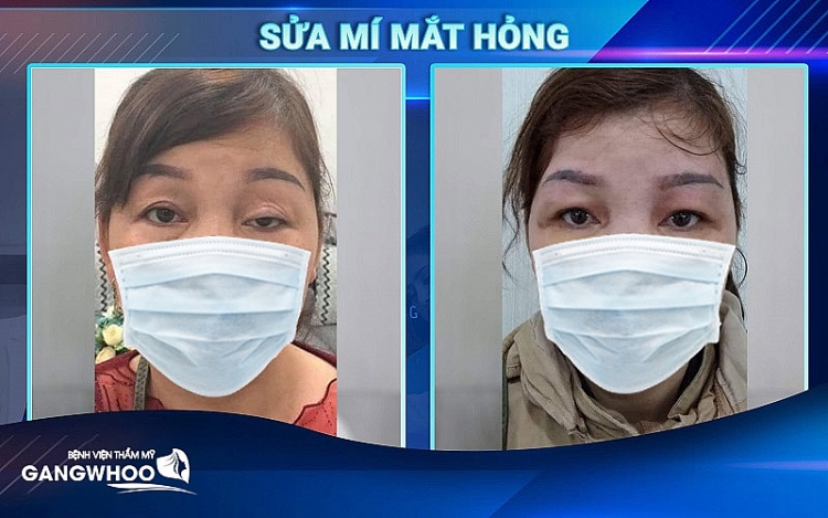 Đôi mắt lấy đi tự tin trong cuộc sống giờ đây đã được khắc phục bởi bệnh viện thẩm mỹ Gangwhoo Đôi mắt lấy đi tự tin trong cuộc sống giờ đây đã được khắc phục bởi bệnh viện thẩm mỹ Gangwhoo