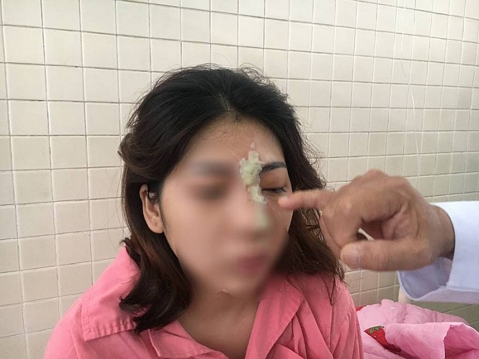 Tiêm filler nâng mũi, thiếu nữ 21 tuổi ở Bình Phước bị mù mắt tiem filler nang mui thieu nu 21 tuoi o binh phuoc bi mu mat