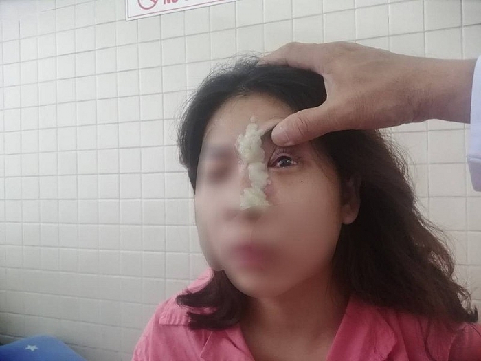 Tiêm filler nâng mũi, thiếu nữ 21 tuổi ở Bình Phước bị mù mắt tiem filler nang mui thieu nu 21 tuoi o binh phuoc bi mu mat
