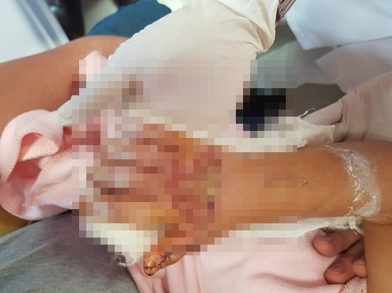 Kỳ tích nối bàn tay gần đứt rời cho bé gái 3 tuổi ky tich noi ban tay gan dut roi cho be gai 3 tuoi