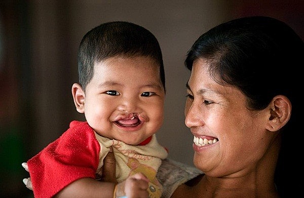 Hàng ngàn trẻ em đã được Operation Smile phẫu thuật miễn phí Hàng ngàn trẻ em đã được Operation Smile phẫu thuật miễn phí