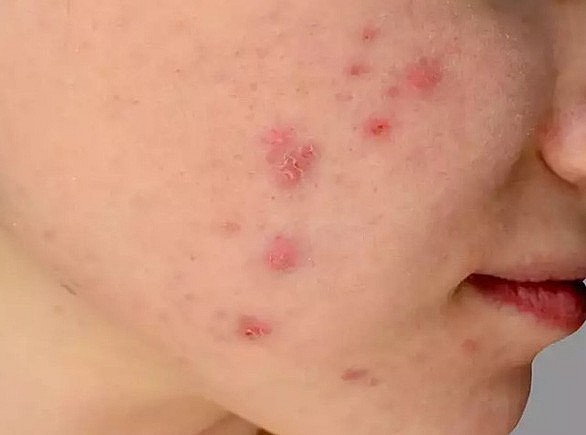 Các nốt trên mặt của một bệnh nhân bị đậu mùa khỉ - Ảnh: indiatimes.com Các nốt trên mặt của một bệnh nhân bị đậu mùa khỉ - Ảnh: indiatimes.com