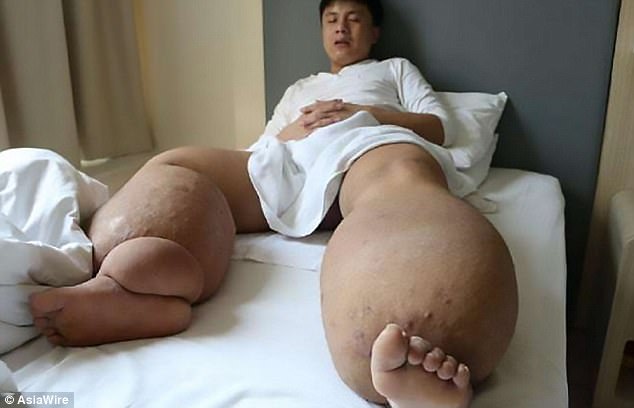 nguoi dan ong co doi chan nang 150kg chi vi mot vet muoi dot