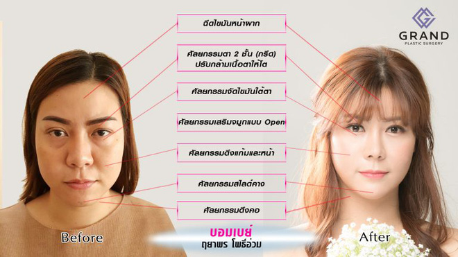 khong hai long voi ve ngoai cua minh thieu nu lot xac xinh ngat ngay sau khi chi 13 ty phau thuat tham my