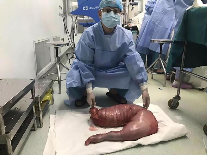 mo bung benh nhan bac si ta hoa khi phat hien khoi dai trang dai 76cm do bi tao bon nhieu nam