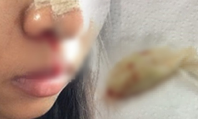 co gai suyt tac tho vi bac si tham my quen lay bang gac trong mui benh nhan