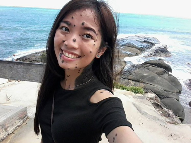 co gai co lan da cham bi not ruoi lam thay doi chuan muc cai dep