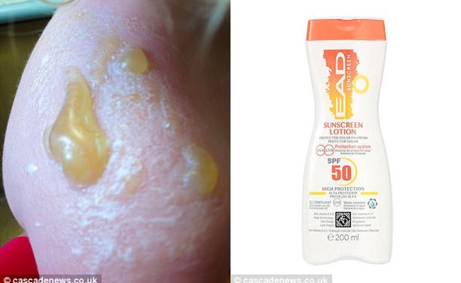 dung kem chong nang spf 50 di da ngoai be trai 3 tuoi bi chay nang va phong rop nghiem trong