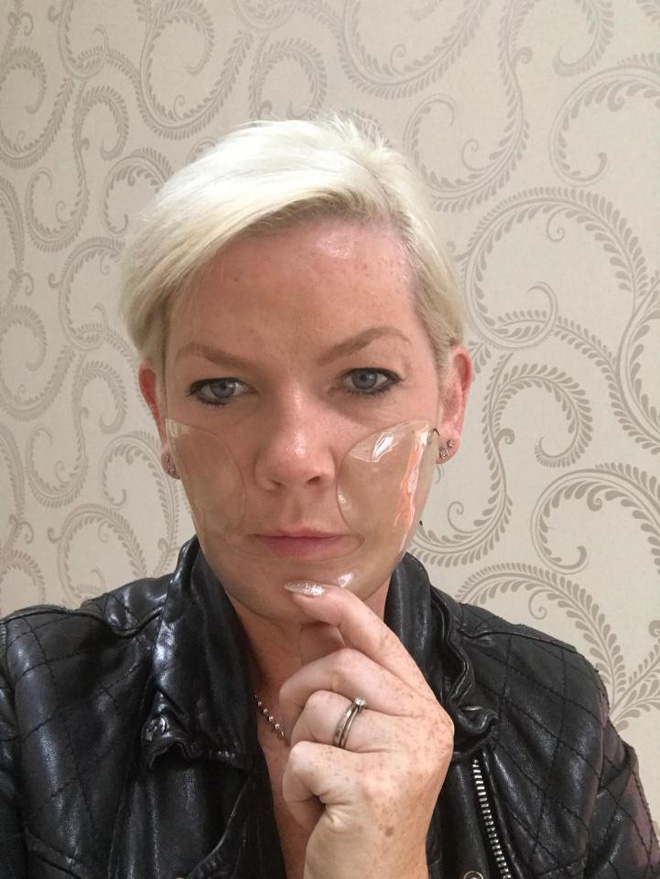 di lot da mat nguoi phu nu nhan cai ket tham thuong khi mat bi phong rop va de lai seo suot doi