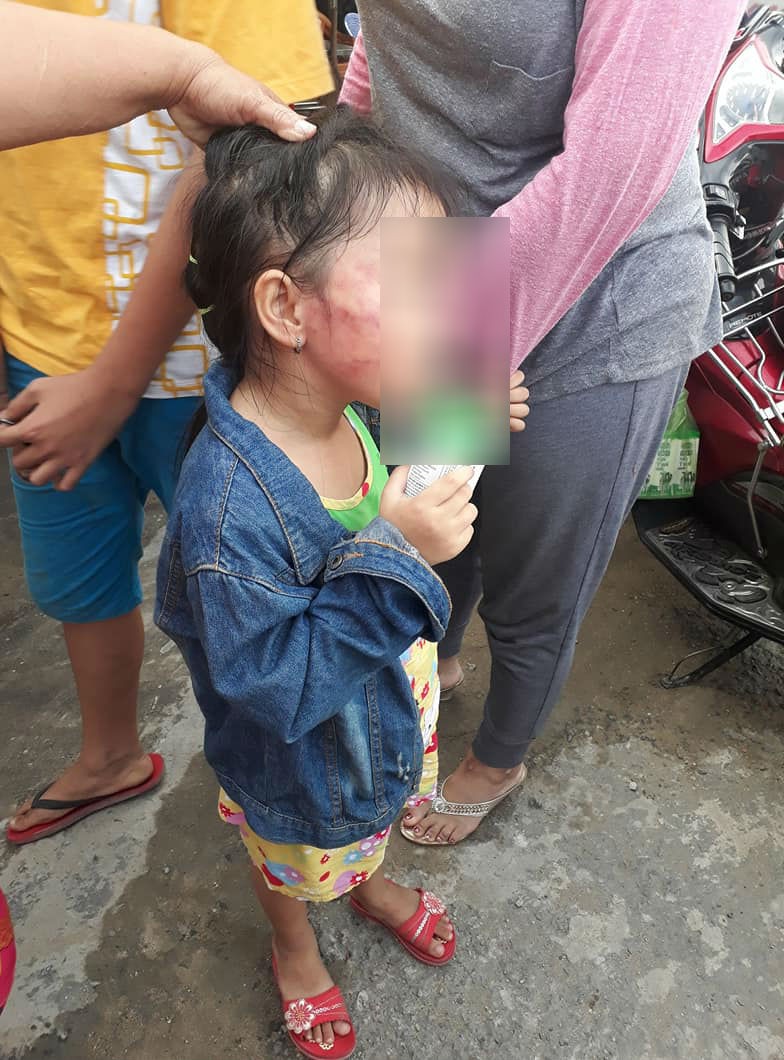 tphcm be gai 5 tuoi nghi bi bao mau tat lien tuc den sung mat doa lay keo cat luoi neu noi cho gia dinh biet
