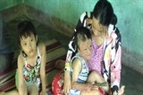 Xót thương số phận đứa bé bị bỏng nặng tại tỉnh Quảng Nam