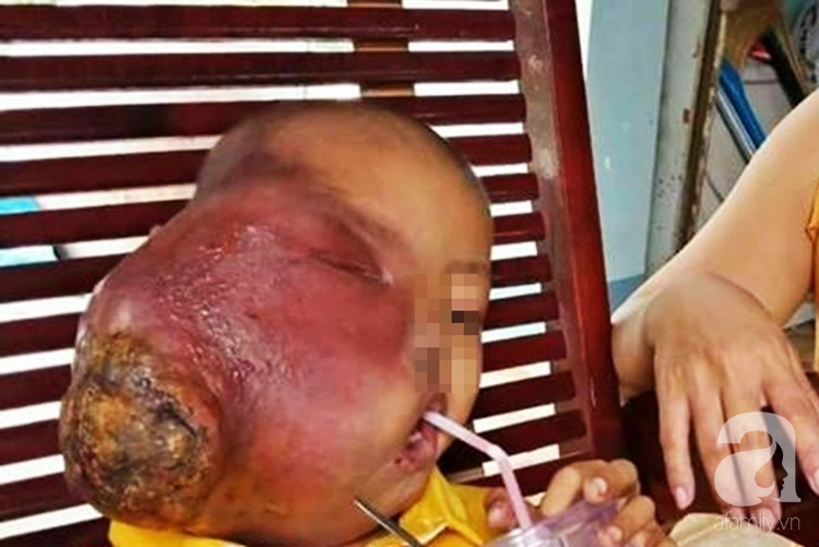 be trai 6 tuoi o tay ninh mang khoi u ac tinh to khung khiep tren mat vi cha dan di dap la thuoc troi noi
