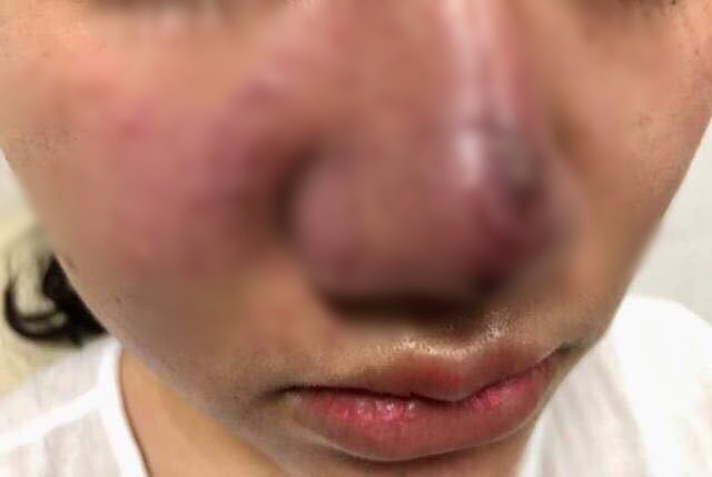 ha noi 3 ngay sau khi tiem filler lam dep o spa co gai tre bi meo cam lech ma