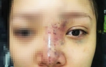 tiem filler nang mui thieu nu 21 tuoi o binh phuoc bi mu mat