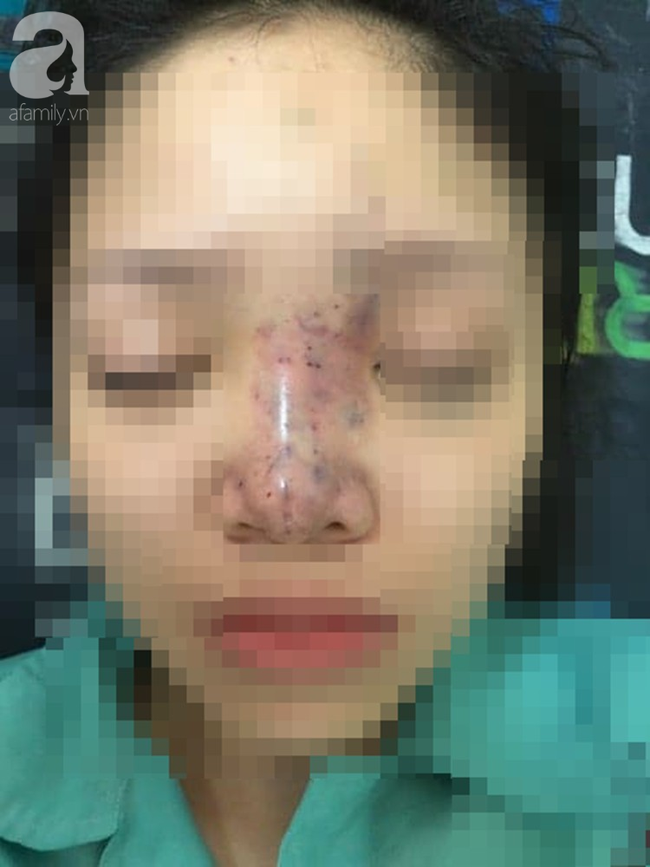 tiem filler nang mui nu sinh vien 20 tuoi o sai gon doi dien nguy co hoai tu da mu mat vinh vien