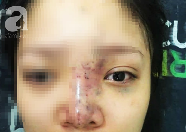 tiem filler nang mui nu sinh vien 20 tuoi o sai gon doi dien nguy co hoai tu da mu mat vinh vien