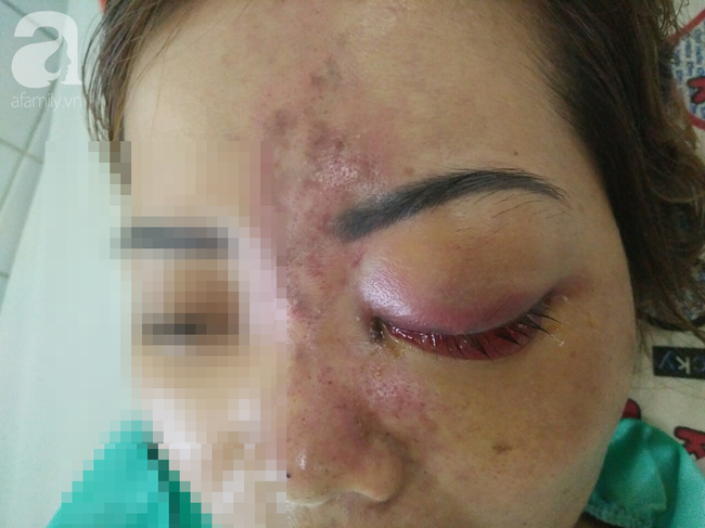 tiem filler nang mui nu sinh vien 20 tuoi o sai gon doi dien nguy co hoai tu da mu mat vinh vien
