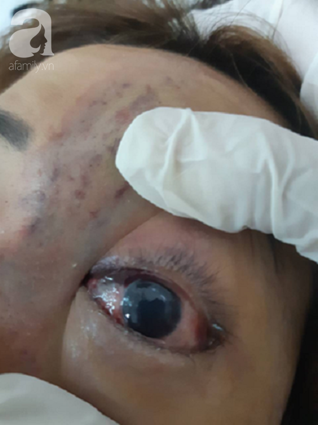 tiem filler nang mui nu sinh vien 20 tuoi o sai gon doi dien nguy co hoai tu da mu mat vinh vien