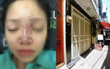 tiem filler nang mui thieu nu 21 tuoi o binh phuoc bi mu mat