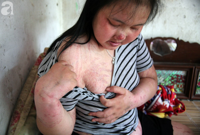 ba me tre bi ung thu giai doan cuoi dau don nhin 2 con tho lam benh ma khong co tien chay chua