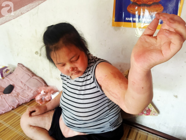 ba me tre bi ung thu giai doan cuoi dau don nhin 2 con tho lam benh ma khong co tien chay chua