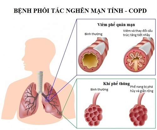 benh vien bach mai kham tu van mien phi ve benh phoi tac nghen man tinh