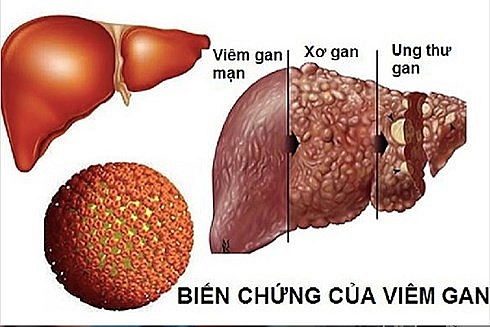 Ung thư gan là gì? Nguyên nhân, triệu chứng và cách điều trị ung thư gan ung thu gan la gi nguyen nhan trieu chung va cach dieu tri ung thu gan