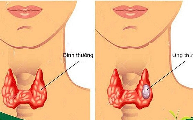 Ung thư tuyến giáp là gì? Nguyên nhân, triệu chứng và cách điều trị ung thư tuyến giáp ung thu tuyen giap la gi nguyen nhan trieu chung va cach dieu tri ung thu tuyen giap
