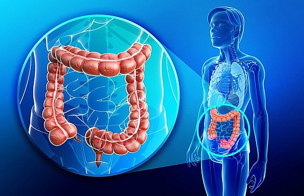 Những phương pháp mới nhất trong điều trị ung thư đại tràng hiện nay nhung phuong phap moi nhat trong dieu tri ung thu dai trang hien nay