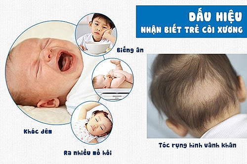 Bệnh còi xương ở trẻ em, những điều nên biết nhung dieu nen biet ve benh coi xuong o tre em