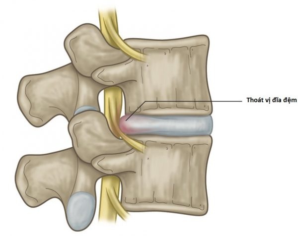 Điều trị thoát vị đĩa đệm bằng bài thuốc nam